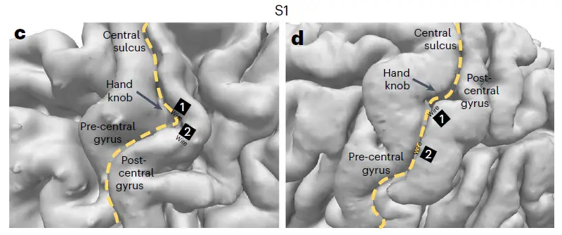 imagem representando os microeletrodos implantados no Córtex Somatossensorial Primário dos dois participantes do estudo da Caltech