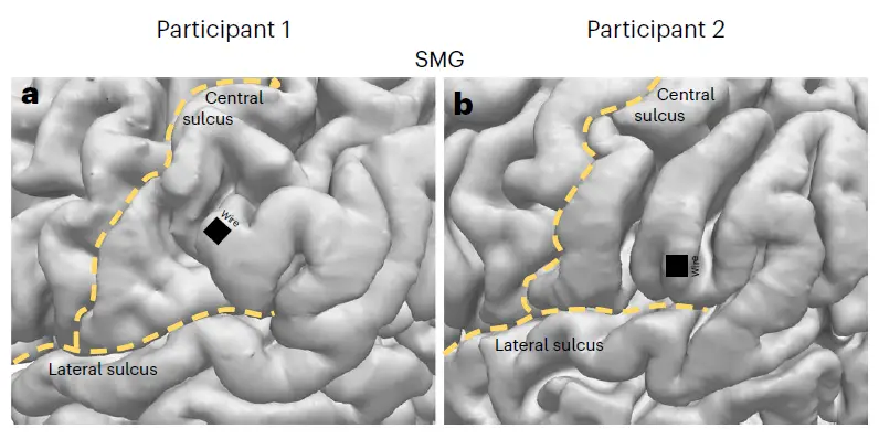 imagem representando os microeletrodos implantados no Giro Supramarginal dos dois participantes do estudo da Caltech